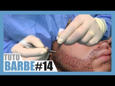 La greffe de barbe, vous connaissez ?